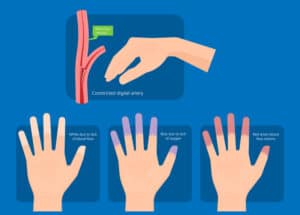 les stades des mains froides, symptôme de la maladie de Raynaud