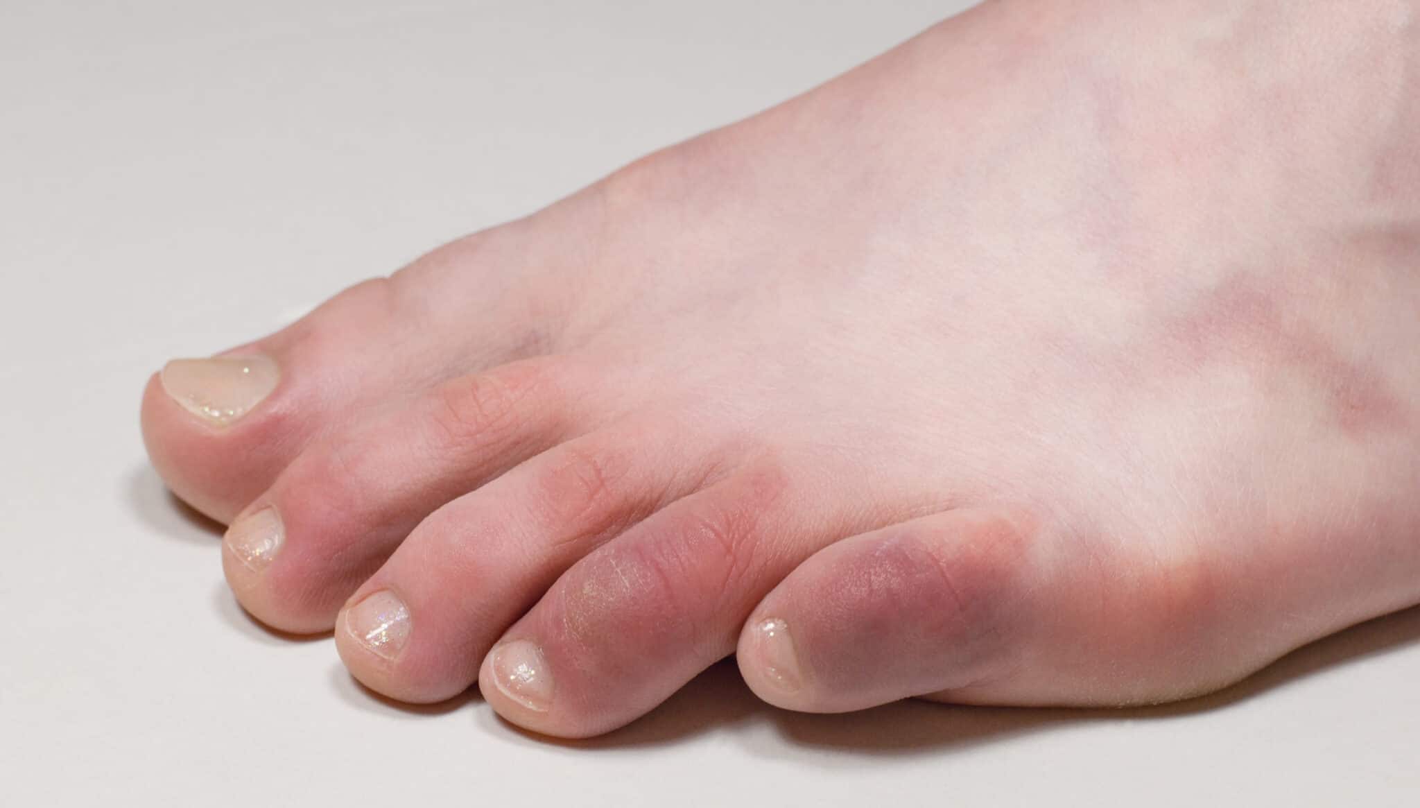 Vous avez souvent froid aux pieds ? 5 conseils essentiels qui fonctionnent vraiment